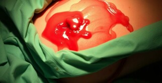 L’hémorragie postopératoire: cuando el silencio de la herida se rompe y cómo actuar con cabeza fría