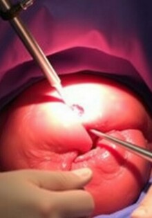 Una sola herida, grandes resultados: Single-Incision Laparoscopic Surgery (SILS) para apendicectomía