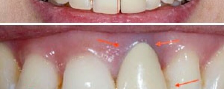 Что такое зубные виниры, плюсы и минусы