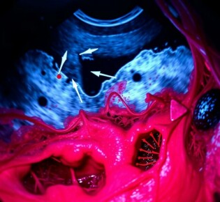 Биопсия под контролем эндоУЗИ: что это такое и почему это важно