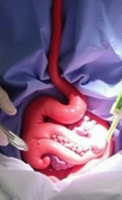 Ernährung vor Appendektomie: So bereiten Sie sich optimal auf die Operation vor