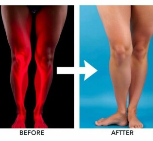 Лечение варикоза лазером: современный подход к проблеме вен