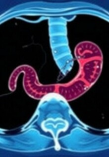 L’abcès appendiculaire : diagnóstico y tratamiento (drenaje) — una guía clara y práctica