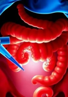Perforación apendicular: causas, peligros y cómo se trata una apendicitis perforada
