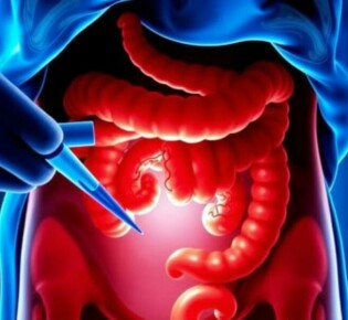 Perforación apendicular: causas, peligros y cómo se trata una apendicitis perforada