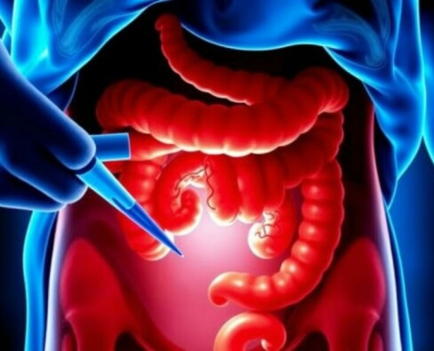 Perforación apendicular: causas, peligros y cómo se trata una apendicitis perforada