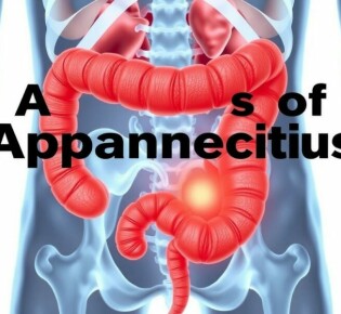 Cuando el apéndice guarda secretos: causas raras de apendicitis (Seltene Ursachen einer Appendizitis, p. ej. tumores y cuerpos extraños)