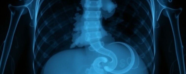 Les limites de la radiographie standard de l’abdomen: por qué ya no siempre basta y cuándo aún tiene sentido usarla