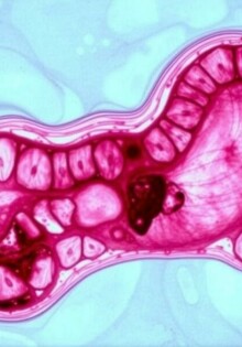 Informe de Patología: Cómo entender los hallazgos tras la extracción del apéndice