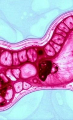 Informe de Patología: Cómo entender los hallazgos tras la extracción del apéndice