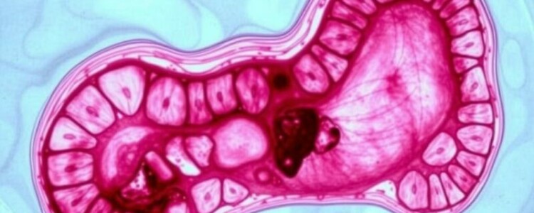 Informe de Patología: Cómo entender los hallazgos tras la extracción del apéndice