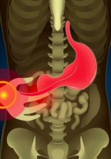 La phase d’obstruction et de distension (douleur colique): Entender la tormenta dentro del abdomen