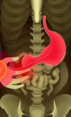 La phase d’obstruction et de distension (douleur colique): Entender la tormenta dentro del abdomen