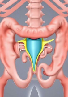 La válvula ileocecal: el pequeño guardián entre intestino delgado y grueso