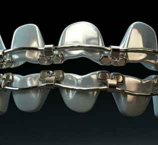 Избавьтесь от проблем с зубами: установка брекетов сегодня легко и доступно