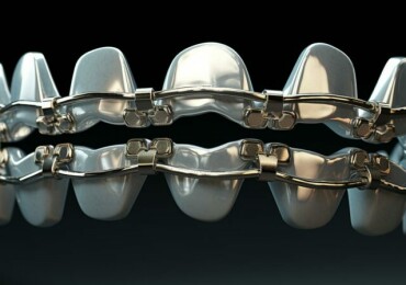 Избавьтесь от проблем с зубами: установка брекетов сегодня легко и доступно