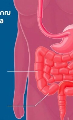 Nausea and Vomiting in Appendicitis: Understanding the Key Symptoms