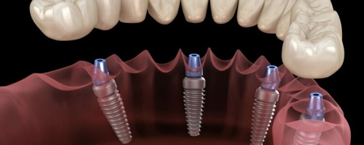 Результаты и ожидания после имплантации зубов на 4 имплантах