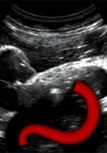 Appendicite et Échographie : Utilité dans le Diagnostic
