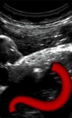 Appendicite et Échographie : Utilité dans le Diagnostic