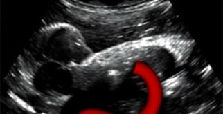 Appendicite et Échographie : Utilité dans le Diagnostic