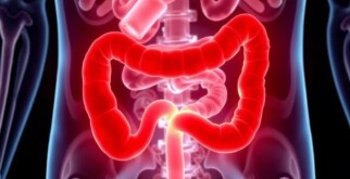 ¿Se puede prevenir la apendicitis? Un vistazo cercano a la evidencia