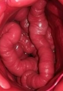 NOTES para apendicectomía: la cirugía que busca desaparecer las cicatrices y reinventar el acceso quirúrgico