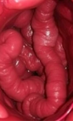 NOTES para apendicectomía: la cirugía que busca desaparecer las cicatrices y reinventar el acceso quirúrgico