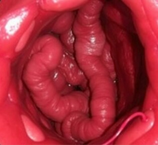 NOTES para apendicectomía: la cirugía que busca desaparecer las cicatrices y reinventar el acceso quirúrgico