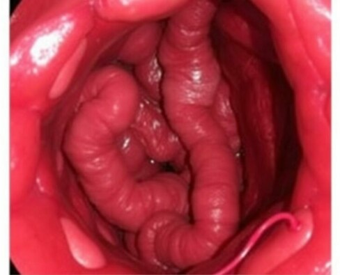NOTES para apendicectomía: la cirugía que busca desaparecer las cicatrices y reinventar el acceso quirúrgico