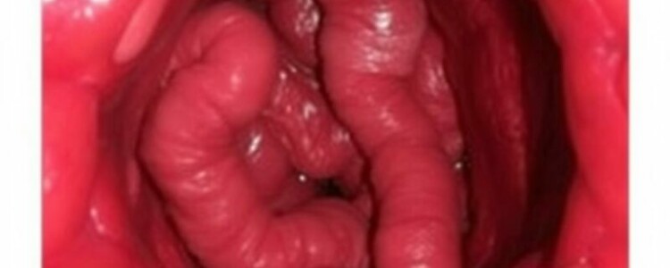 NOTES para apendicectomía: la cirugía que busca desaparecer las cicatrices y reinventar el acceso quirúrgico