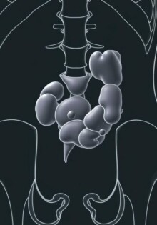 Plastrón apendicular: comprender, reconocer y manejar una complicación silenciosa de la apendicitis