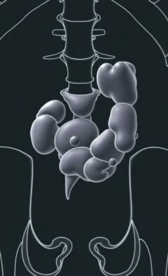 Plastrón apendicular: comprender, reconocer y manejar una complicación silenciosa de la apendicitis