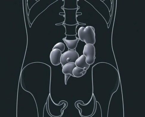 Plastrón apendicular: comprender, reconocer y manejar una complicación silenciosa de la apendicitis