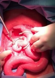 Intraoperative Befunde bei Appendizitis: Ein umfassender Leitfaden für Chirurgen und Mediziner