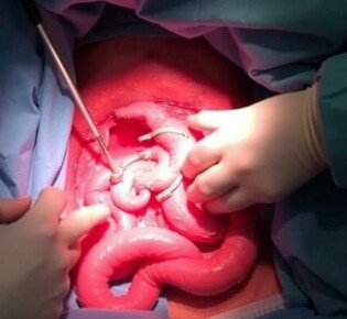Intraoperative Befunde bei Appendizitis: Ein umfassender Leitfaden für Chirurgen und Mediziner