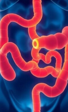 Appendicitis and Bowel Obstruction: Understanding Causes, Symptoms, and Treatments