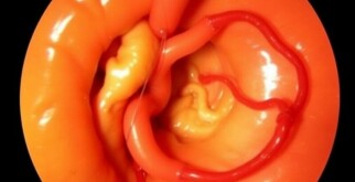 Fadenfistel nach Appendektomie: Ursachen, Symptome und moderne Behandlungsmöglichkeiten