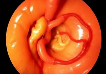 Fadenfistel nach Appendektomie: Ursachen, Symptome und moderne Behandlungsmöglichkeiten