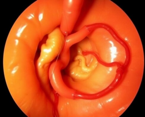 Fadenfistel nach Appendektomie: Ursachen, Symptome und moderne Behandlungsmöglichkeiten