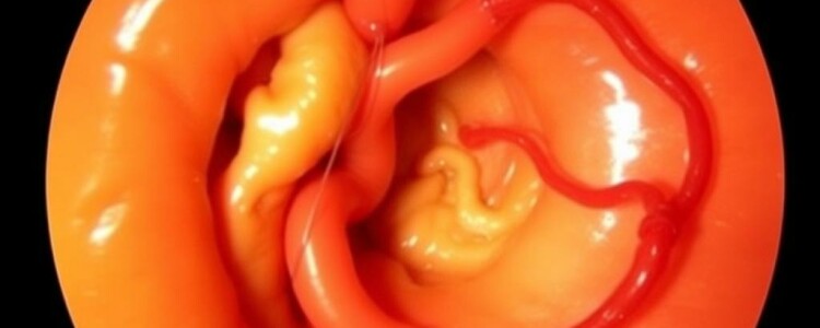 Fadenfistel nach Appendektomie: Ursachen, Symptome und moderne Behandlungsmöglichkeiten