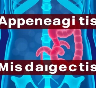 Appendicitis Misdiagnosis: Understanding the Challenges and Preventing Errors