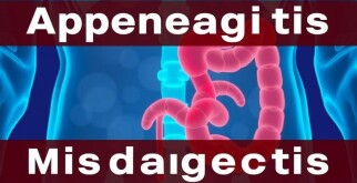 Appendicitis Misdiagnosis: Understanding the Challenges and Preventing Errors