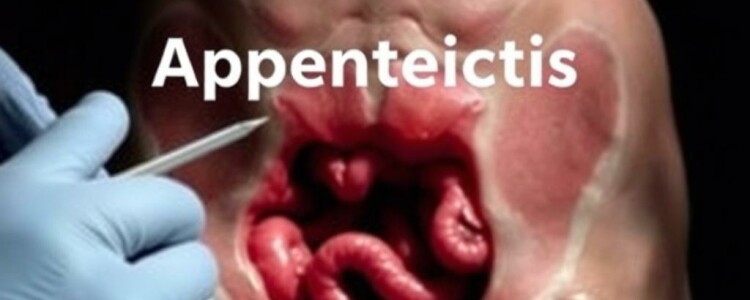 Famous Cases of Appendicitis: Stories That Shaped Medical History