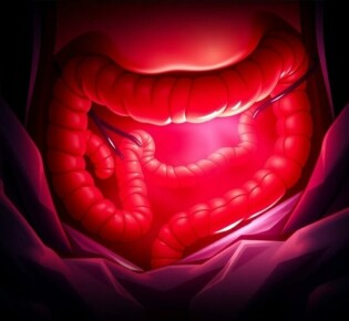 Understanding the Critical Connection Between Appendicitis and Sepsis