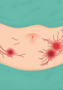 Understanding and Managing Scarring After Appendectomy: What You Need to Know