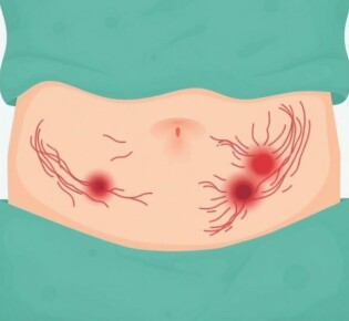 Understanding and Managing Scarring After Appendectomy: What You Need to Know