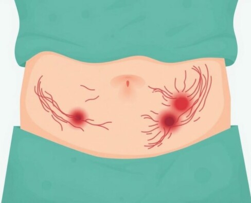 Understanding and Managing Scarring After Appendectomy: What You Need to Know