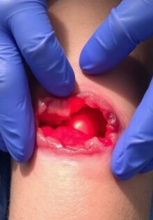 Cuando la piel cede: entendiendo la infección de la herida quirúrgica y la dehiscencia