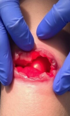 Cuando la piel cede: entendiendo la infección de la herida quirúrgica y la dehiscencia